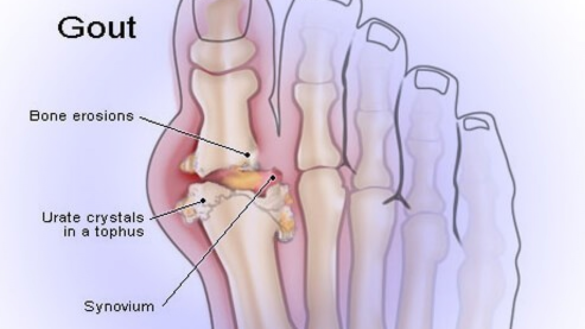 benh-gout-la-gi - yensaovinhphuoc.vn
