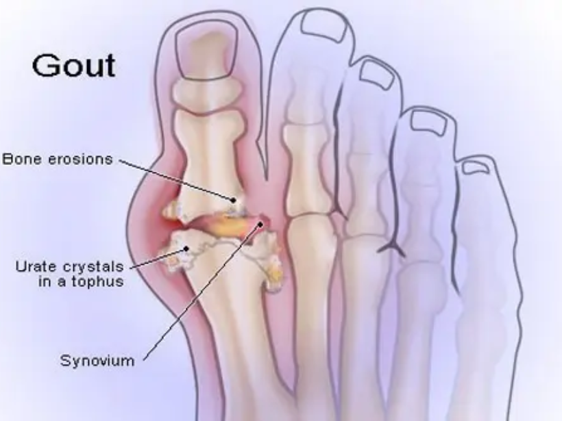 benh-gout-la-gi - yensaovinhphuoc.vn