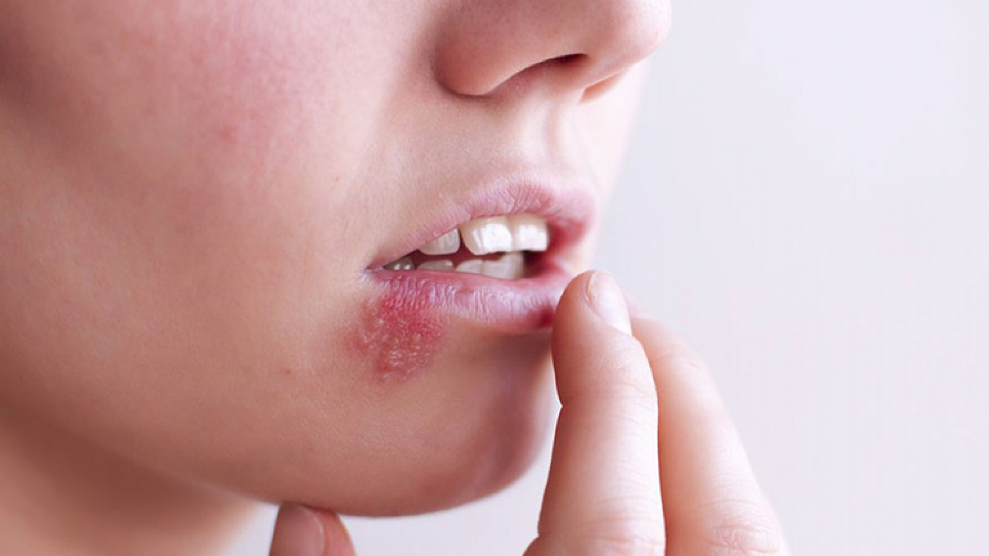 Zona thần kinh cần tránh những thực phẩm nào - yensaovinhphuoc (1)