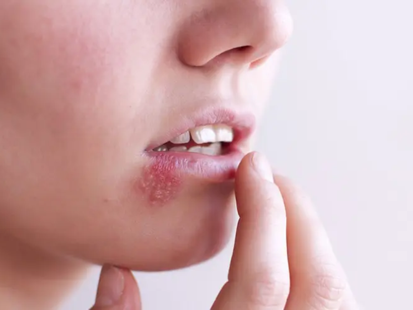 Zona thần kinh cần tránh những thực phẩm nào - yensaovinhphuoc (1)