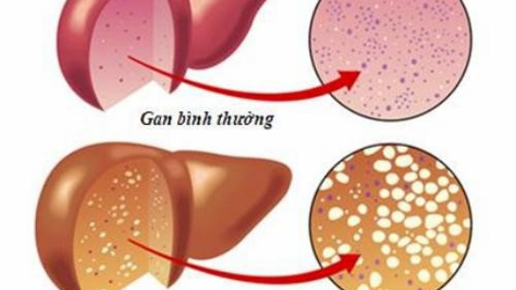 gan nhiễm mỡ - yensaovinhphuoc