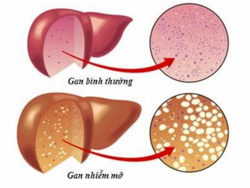 gan nhiễm mỡ - yensaovinhphuoc