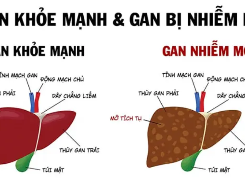 gan nhiễm mỡ - yensaovinhphuoc