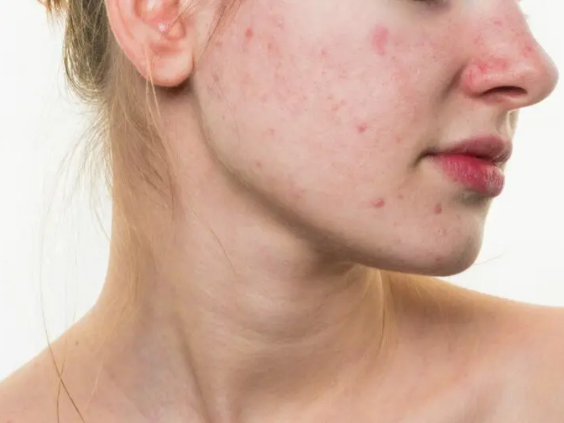 Thực phẩm nên ăn để cải thiện tình trạng mụn - yensaovinhphuoc (6)