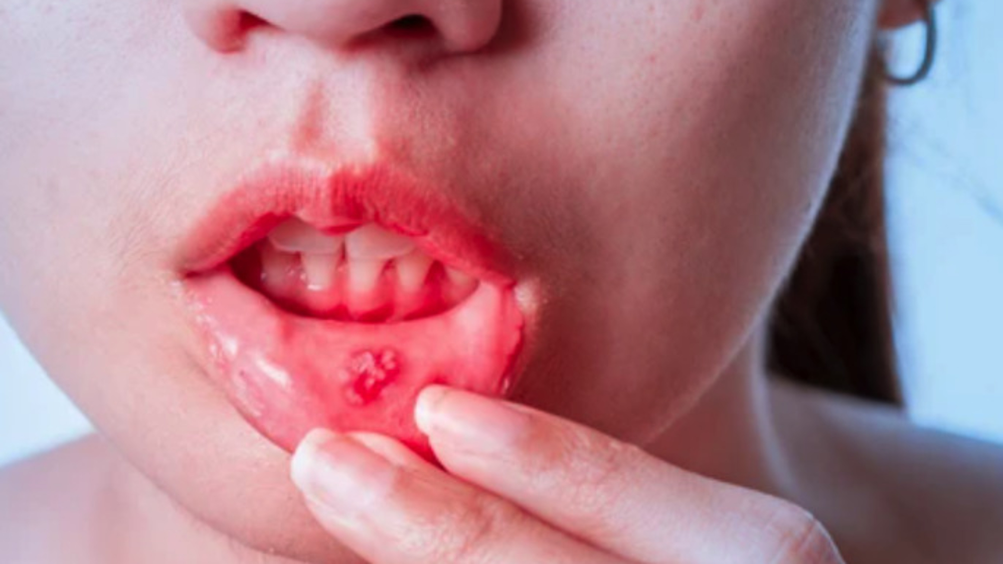 nhung-bai-thuoc-dan-gian-chua-tri-benh-nhiet-mieng-hieu-qua-yensaovinhphuoc (1)