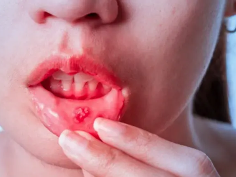 nhung-bai-thuoc-dan-gian-chua-tri-benh-nhiet-mieng-hieu-qua-yensaovinhphuoc (1)