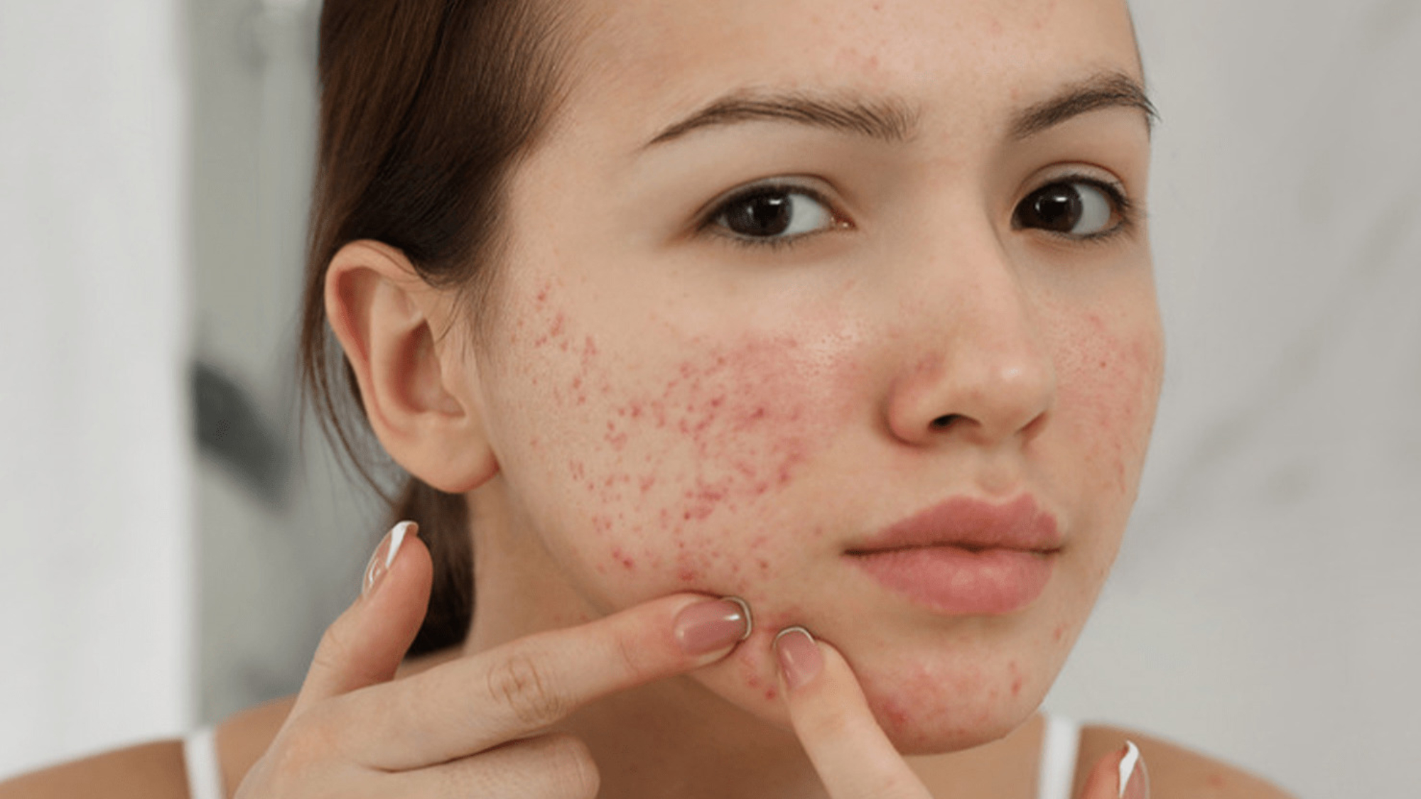 nen-an-gi-khi-bi-noi-mun-yensaovinhphuoc