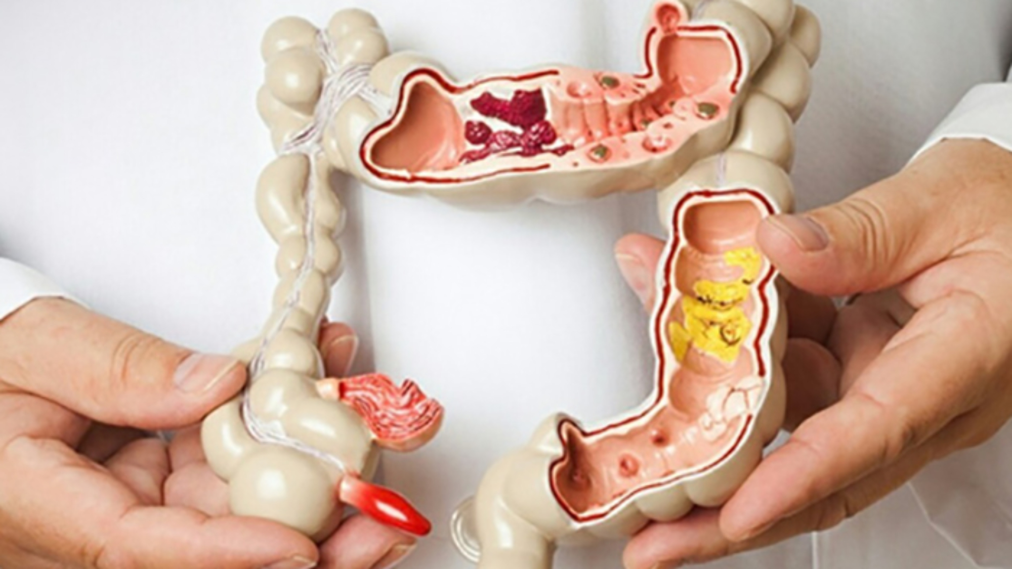 ung thư đại tràng sống được bao lâu